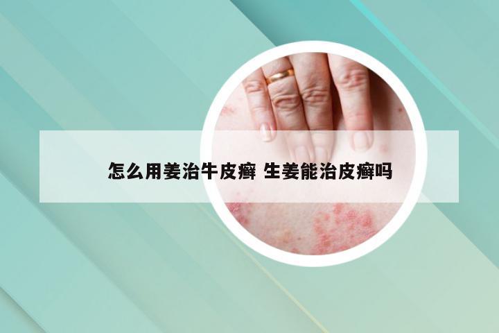 怎么用姜治牛皮癣 生姜能治皮癣吗