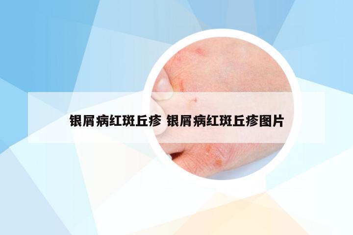 银屑病红斑丘疹 银屑病红斑丘疹图片