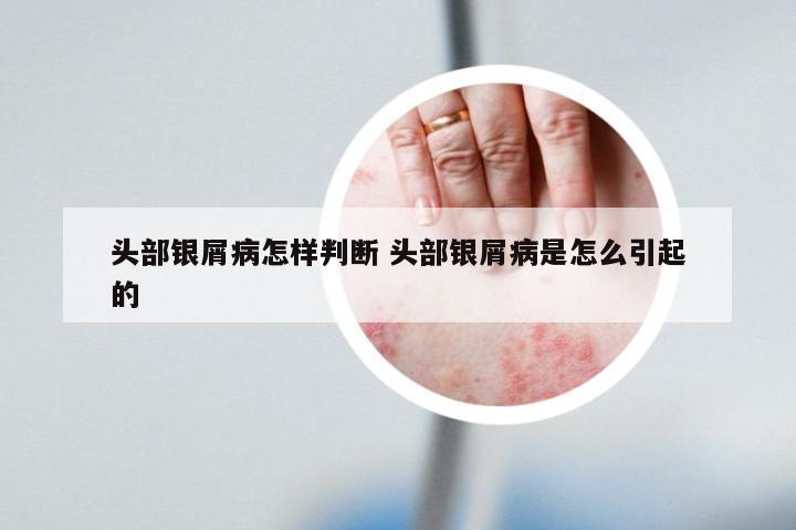 头部银屑病怎样判断 头部银屑病是怎么引起的