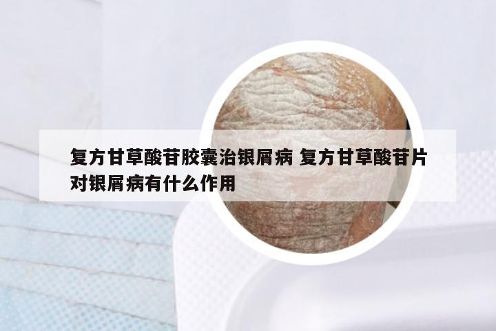 复方甘草酸苷胶囊治银屑病 复方甘草酸苷片对银屑病有什么作用