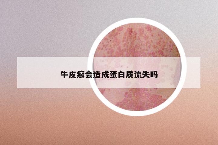 牛皮癣会造成蛋白质流失吗