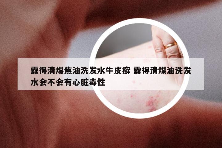 露得清煤焦油洗发水牛皮癣 露得清煤油洗发水会不会有心脏毒性