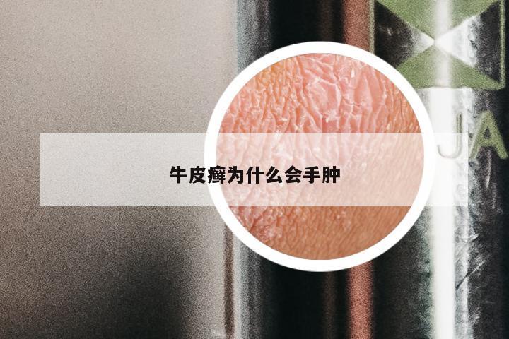 牛皮癣为什么会手肿