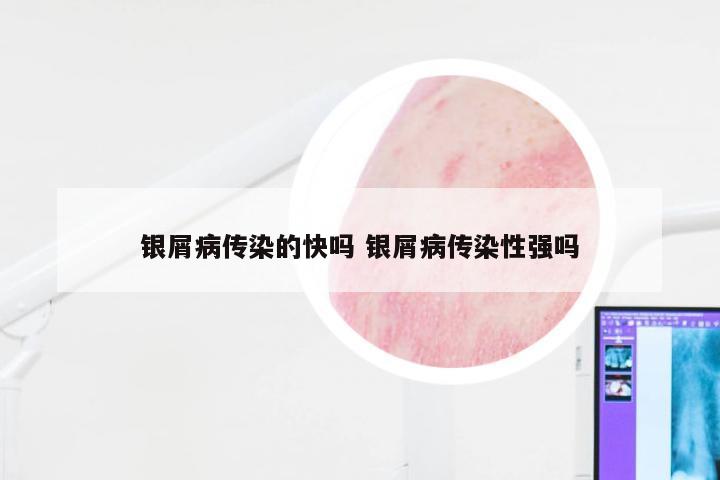 银屑病传染的快吗 银屑病传染性强吗
