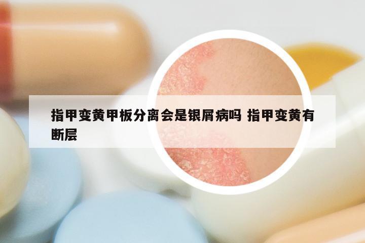 指甲变黄甲板分离会是银屑病吗 指甲变黄有断层