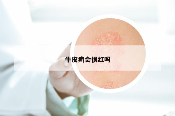 牛皮癣会很红吗
