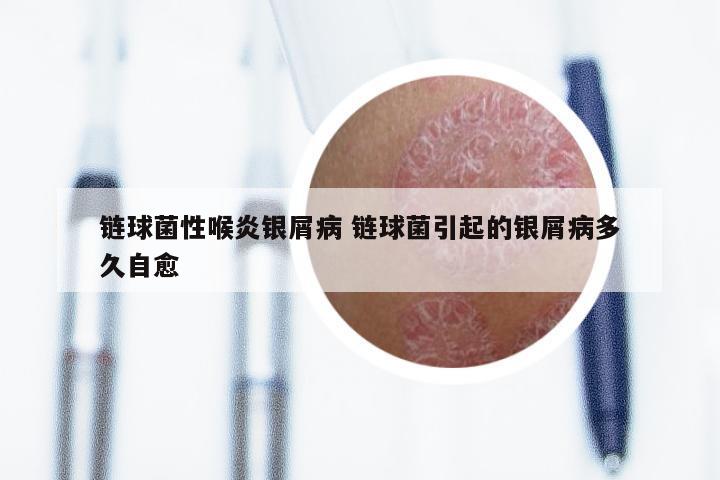 链球菌性喉炎银屑病 链球菌引起的银屑病多久自愈
