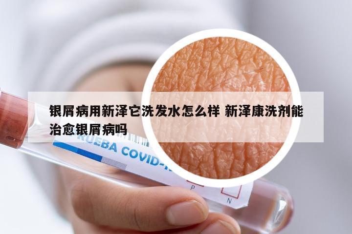 银屑病用新泽它洗发水怎么样 新泽康洗剂能治愈银屑病吗