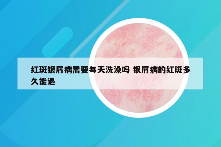 红斑银屑病需要每天洗澡吗 银屑病的红斑多久能退