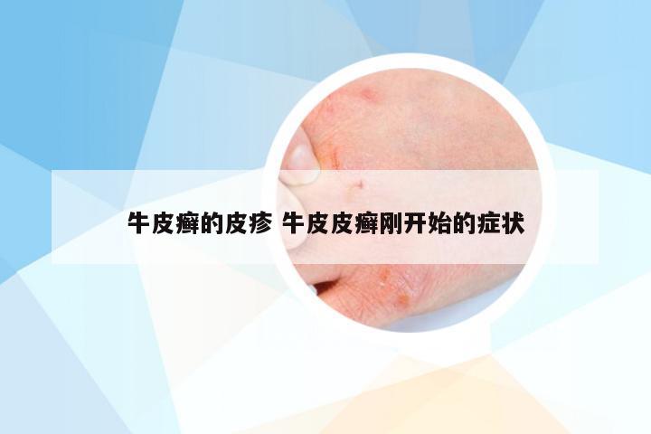 牛皮癣的皮疹 牛皮皮癣刚开始的症状