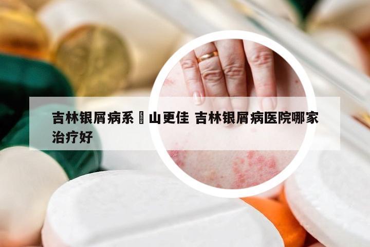 吉林银屑病系崋山更佳 吉林银屑病医院哪家治疗好