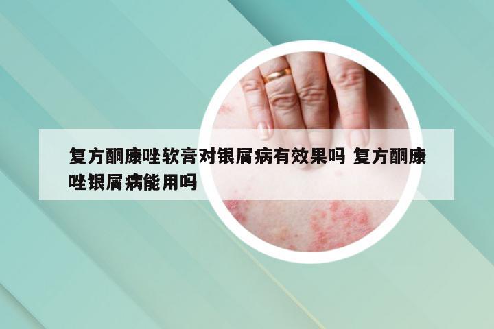 复方酮康唑软膏对银屑病有效果吗 复方酮康唑银屑病能用吗