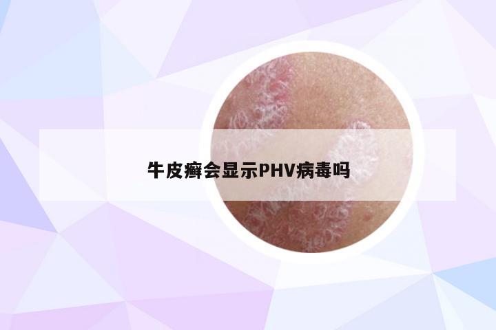 牛皮癣会显示PHV病毒吗