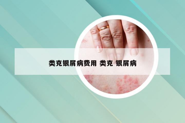 类克银屑病费用 类克 银屑病