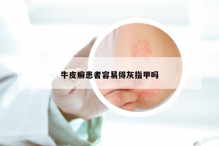 牛皮癣患者容易得灰指甲吗