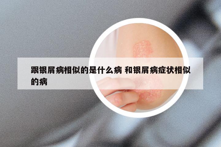 跟银屑病相似的是什么病 和银屑病症状相似的病