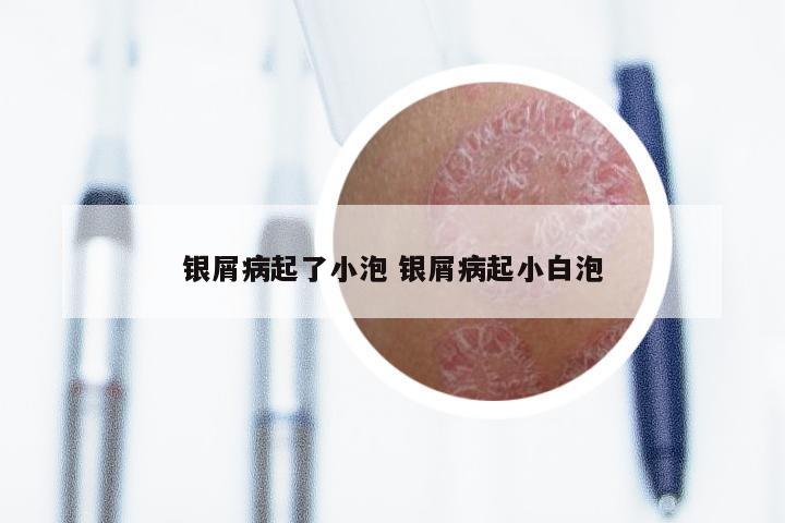 银屑病起了小泡 银屑病起小白泡