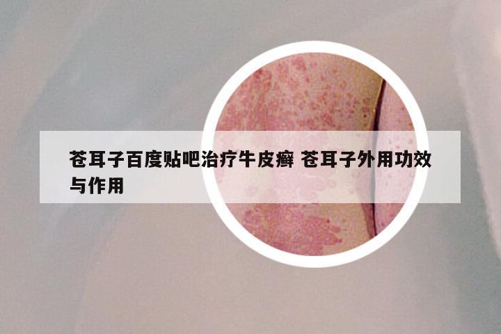 苍耳子百度贴吧治疗牛皮癣 苍耳子外用功效与作用