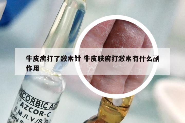 牛皮癣打了激素针 牛皮肤癣打激素有什么副作用