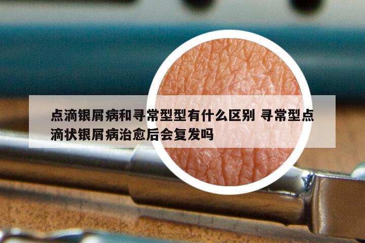点滴银屑病和寻常型型有什么区别 寻常型点滴状银屑病治愈后会复发吗