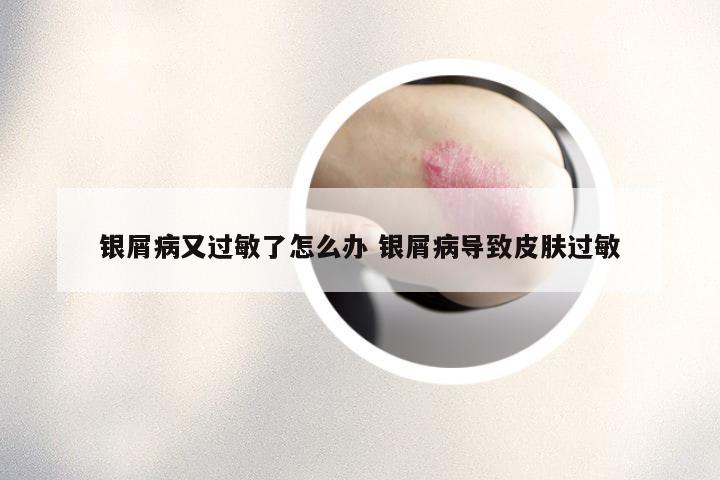 银屑病又过敏了怎么办 银屑病导致皮肤过敏