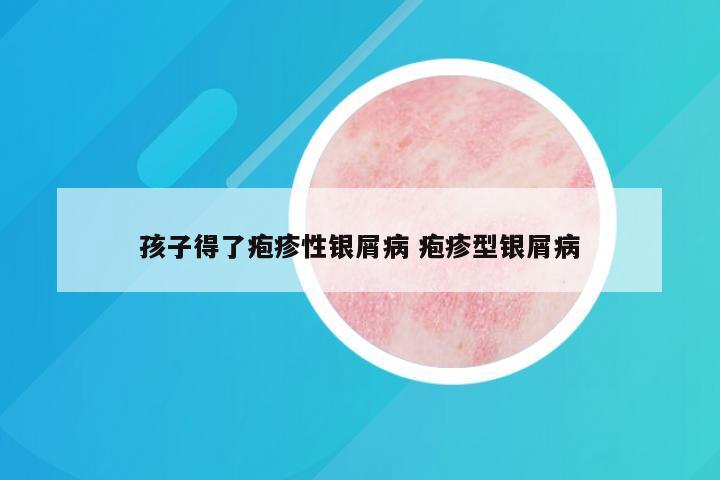 孩子得了疱疹性银屑病 疱疹型银屑病