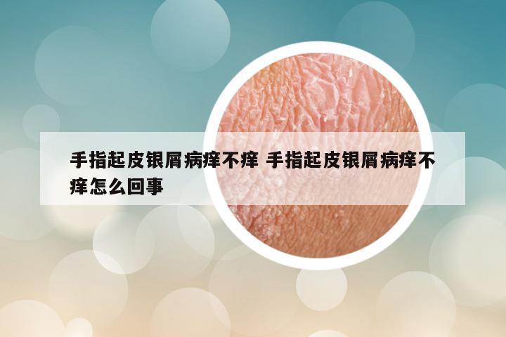 手指起皮银屑病痒不痒 手指起皮银屑病痒不痒怎么回事