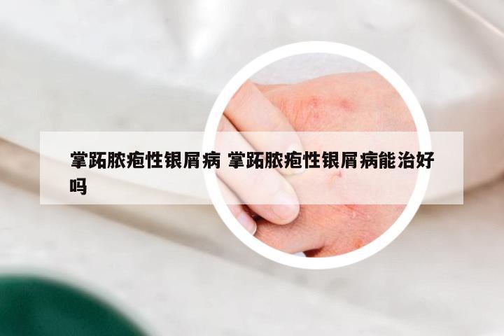 掌跖脓疱性银屑病 掌跖脓疱性银屑病能治好吗