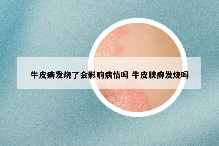 牛皮癣发烧了会影响病情吗 牛皮肤癣发烧吗