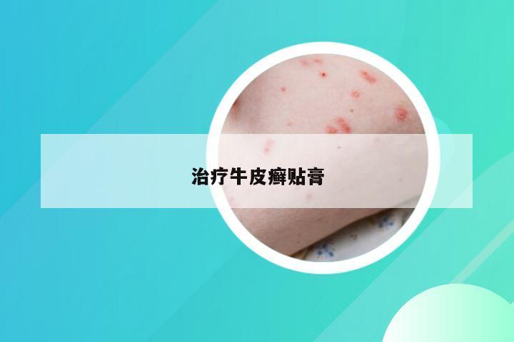 治疗牛皮癣贴膏