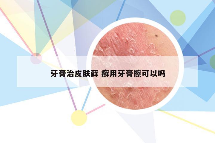 牙膏治皮肤藓 癣用牙膏擦可以吗