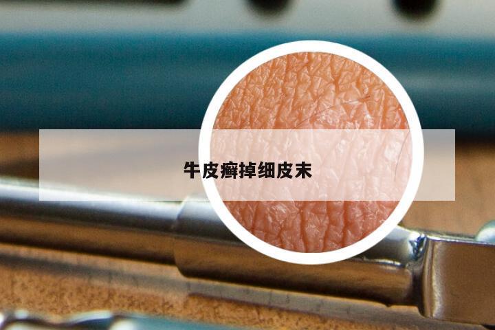 牛皮癣掉细皮末
