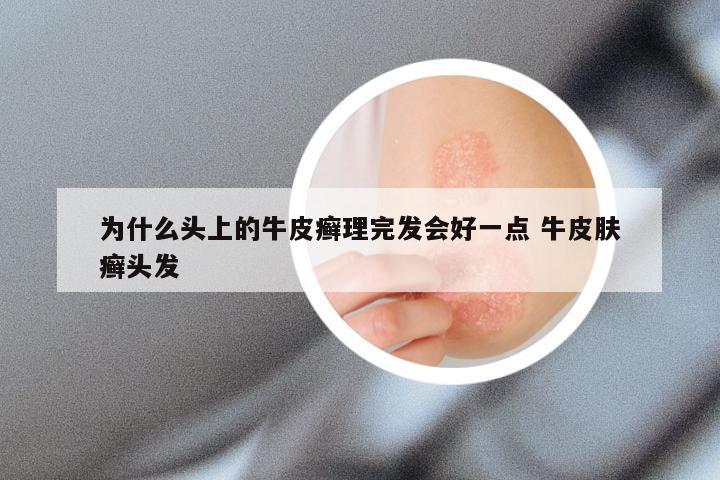 为什么头上的牛皮癣理完发会好一点 牛皮肤癣头发