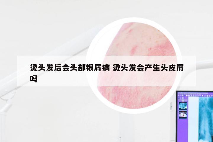 烫头发后会头部银屑病 烫头发会产生头皮屑吗