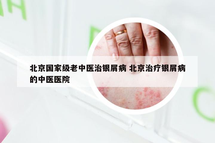 北京国家级老中医治银屑病 北京治疗银屑病的中医医院