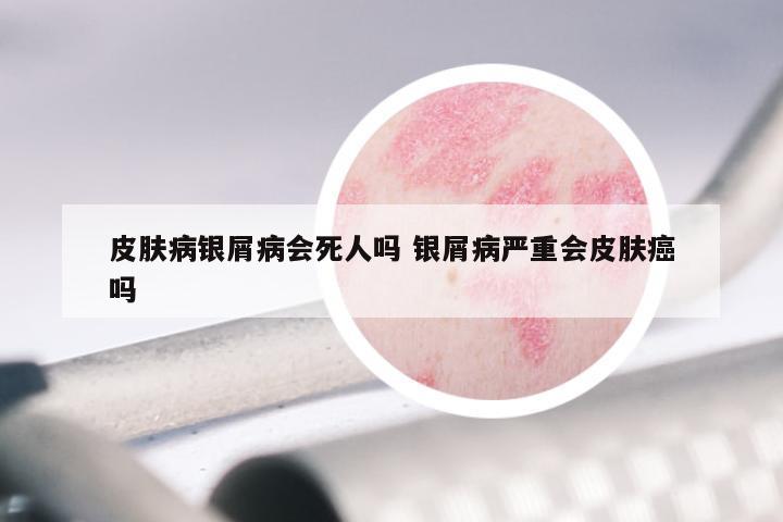 皮肤病银屑病会死人吗 银屑病严重会皮肤癌吗