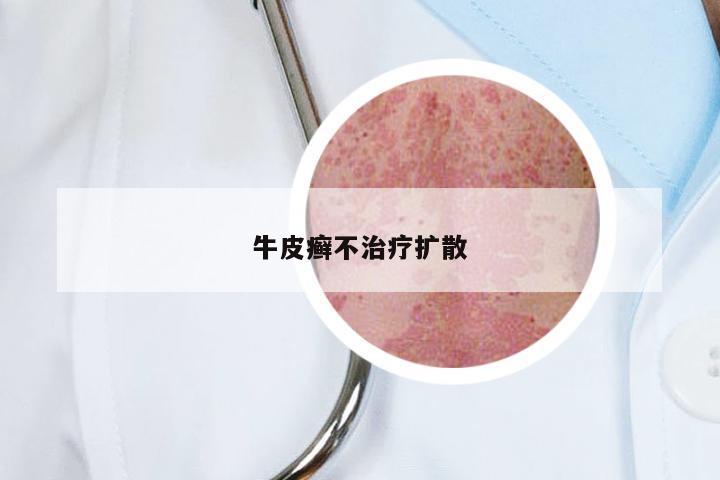 牛皮癣不治疗扩散