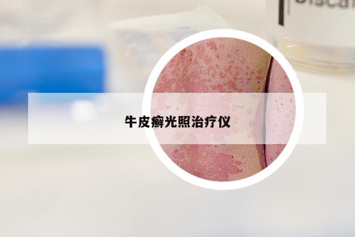 牛皮癣光照治疗仪