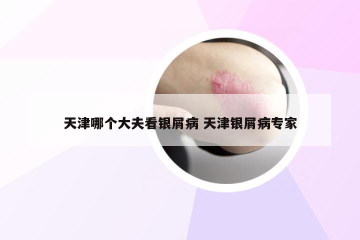 天津哪个大夫看银屑病 天津银屑病专家
