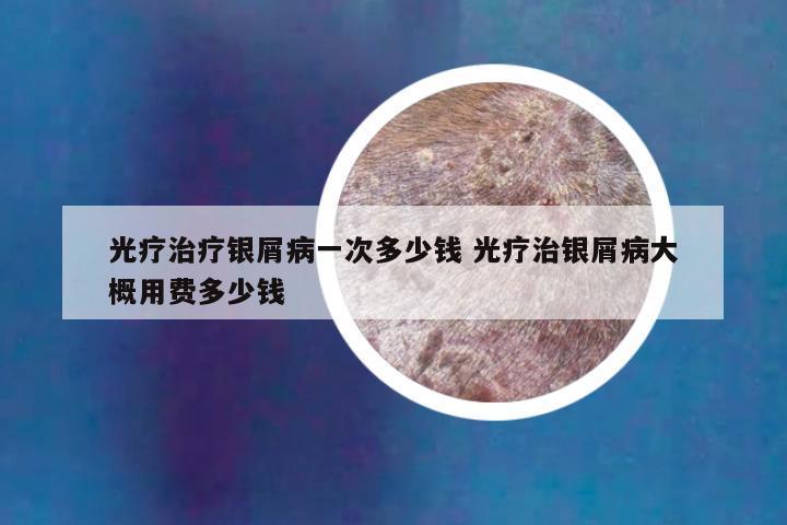 光疗治疗银屑病一次多少钱 光疗治银屑病大概用费多少钱