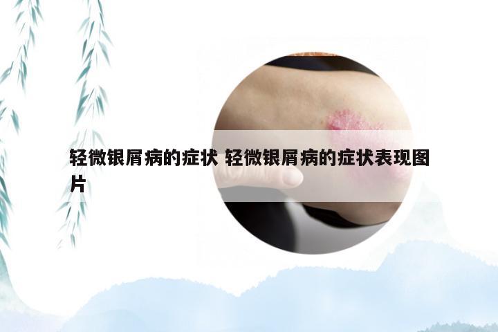 轻微银屑病的症状 轻微银屑病的症状表现图片
