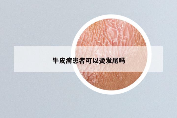 牛皮癣患者可以烫发尾吗