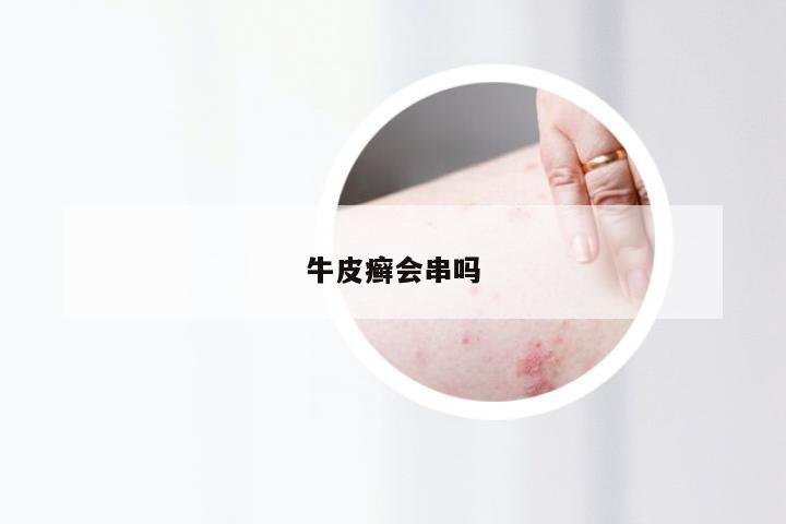 牛皮癣会串吗