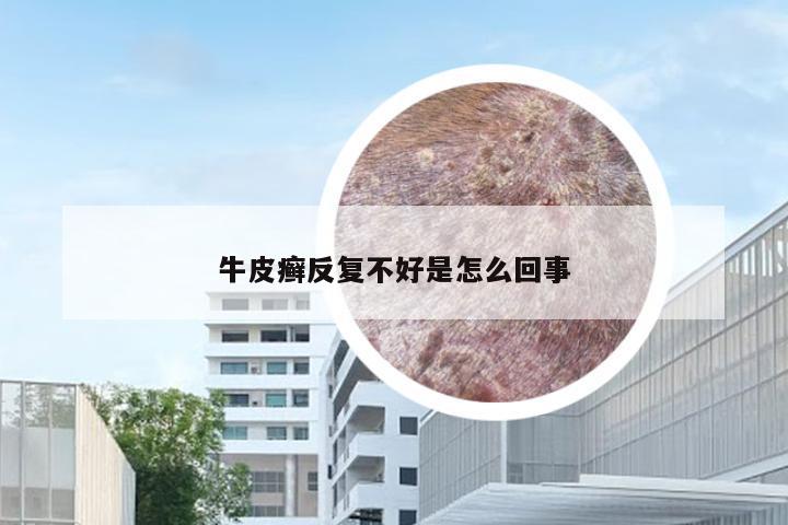 牛皮癣反复不好是怎么回事