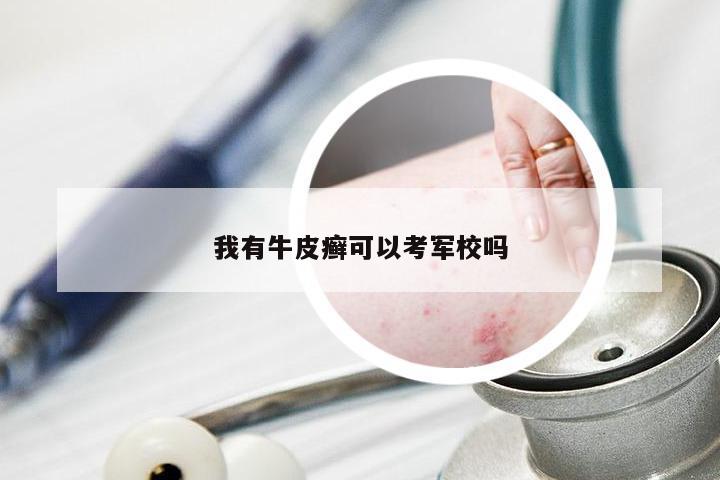 我有牛皮癣可以考军校吗