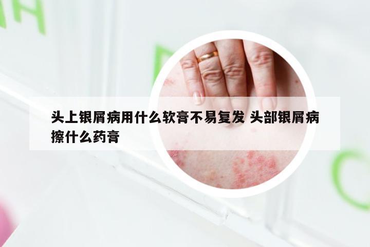 头上银屑病用什么软膏不易复发 头部银屑病擦什么药膏