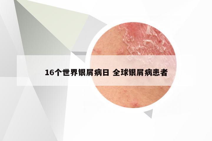 16个世界银屑病日 全球银屑病患者