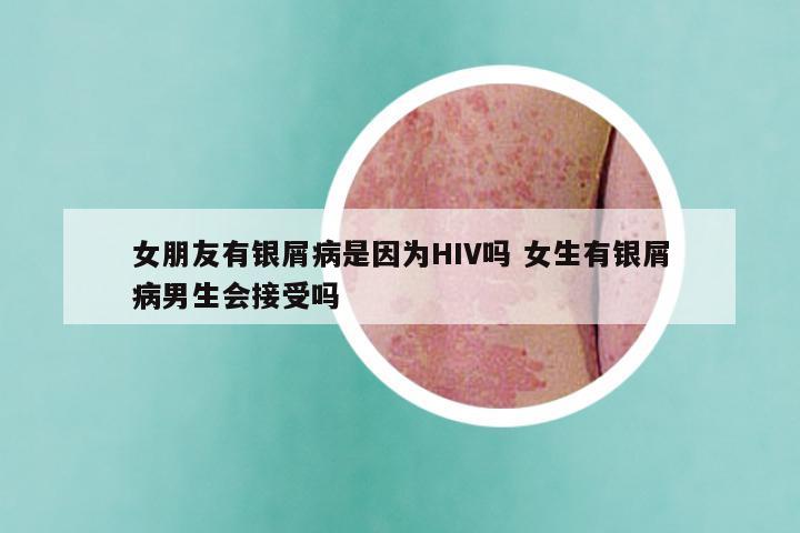 女朋友有银屑病是因为HIV吗 女生有银屑病男生会接受吗