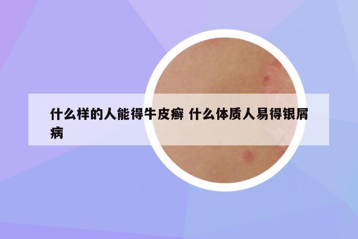 什么样的人能得牛皮癣 什么体质人易得银屑病