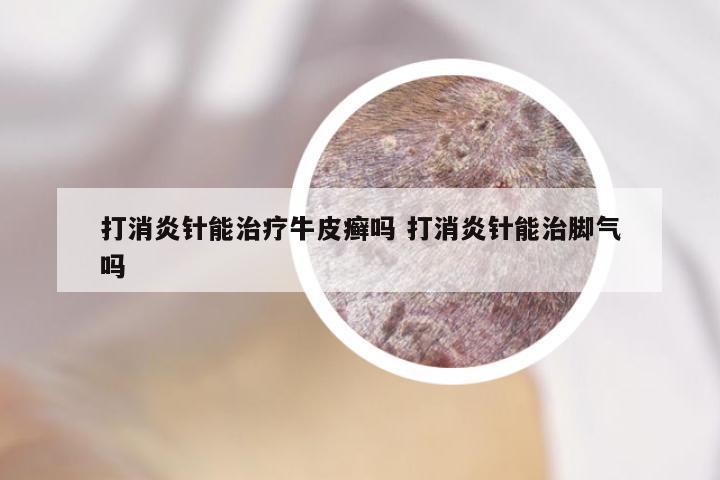 打消炎针能治疗牛皮癣吗 打消炎针能治脚气吗